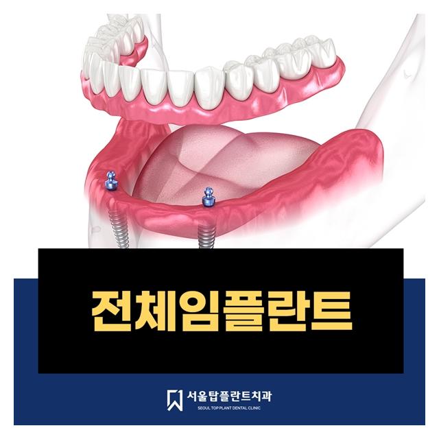 전체임플란트 엄선된 재료를 사용해 안전한 임플란트 식립